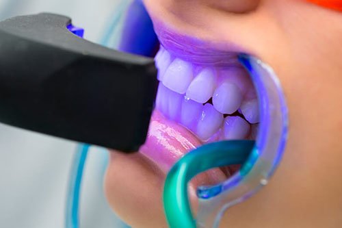 Tooth Whitening