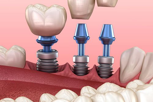 Teeth Implants