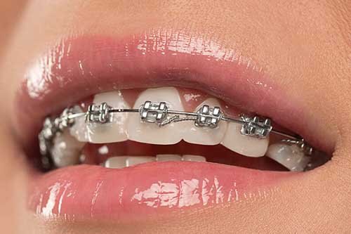 Dental Braces