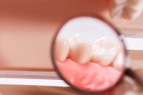 Gum Disease Treatment