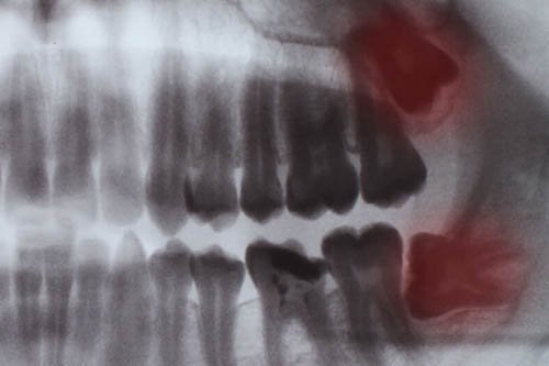 Wisdom Tooth Extraction